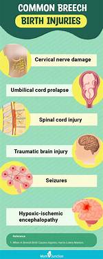 Characteristics of Breech Birth Adults