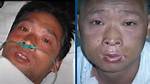 Hisashi Ouchi: Did He Survive the Lethal Radiation Exposure?