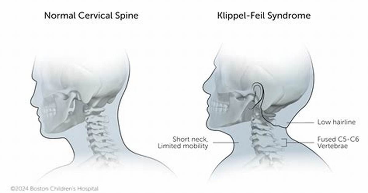 How Big Ed's Klippel-Feil Syndrome Has Affected Him