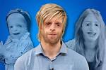 Inspiring Lives: Treacher Collins Syndrome Famous People