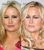 Jennifer Coolidge Botox and Lip Filler Before and After Photos, Beauty Secret Explored!