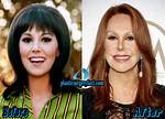 Marlo Thomas Plastic Surgery: a Timeline of Cosmetic Enhancements