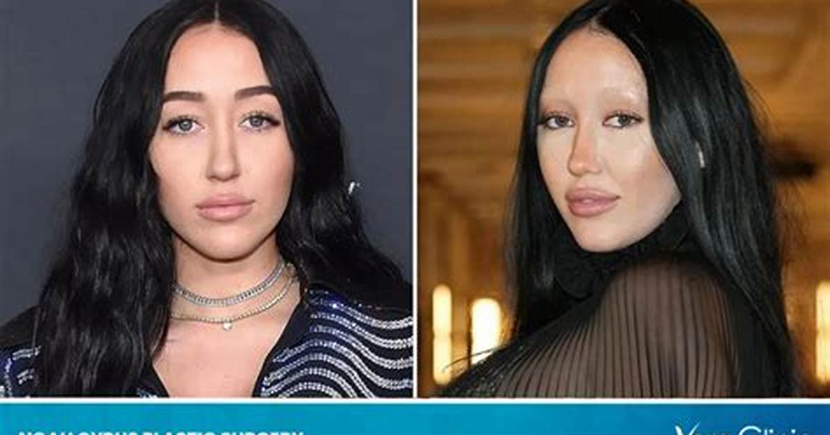 Noah Cyrus’s Plastic Surgery Speculations and Experts’ Opinions on Her Appearance
