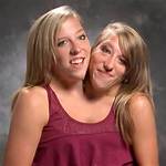 Remembering the Lives of Conjoined Twins Abby and Brittany