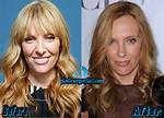 Toni Collette Teeth Before and After | What Is Wrong with Her Face