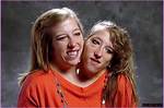 Tragic Passing: Conjoined Twins Abby and Brittany Hensel Die