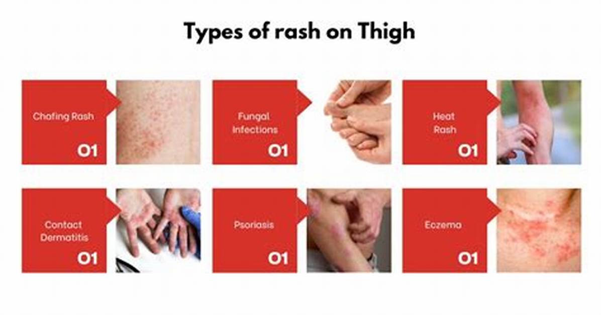Understanding and Managing Inner Thigh Rash: a Comprehensive Guide