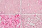 Understanding Kidney Surgery Scars: What to Expect