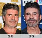 Unveiling the Transformation: Simon Cowell's Pre-Botox Era