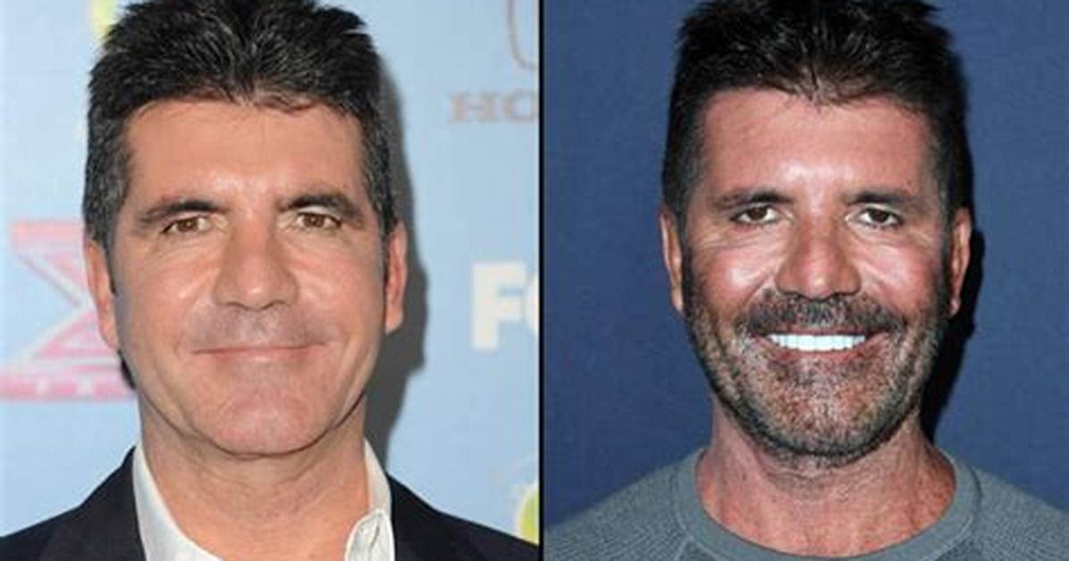 What's the Truth About Simon Cowell's Mysterious Eye Condition?